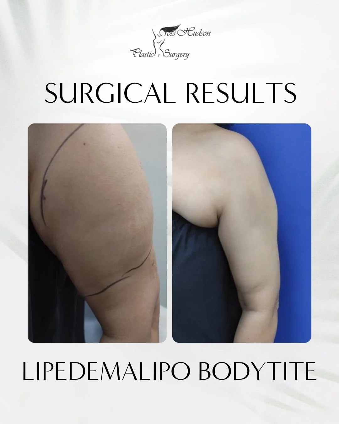 Cross Hudson Plastic Surgery logo with surgical results heading and before/after thigh lift photos showing improved contour